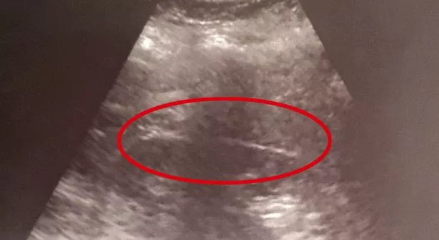 在克罗地亚度假时,妈妈吞下20厘米长的牙刷,“幸运地活了下来”